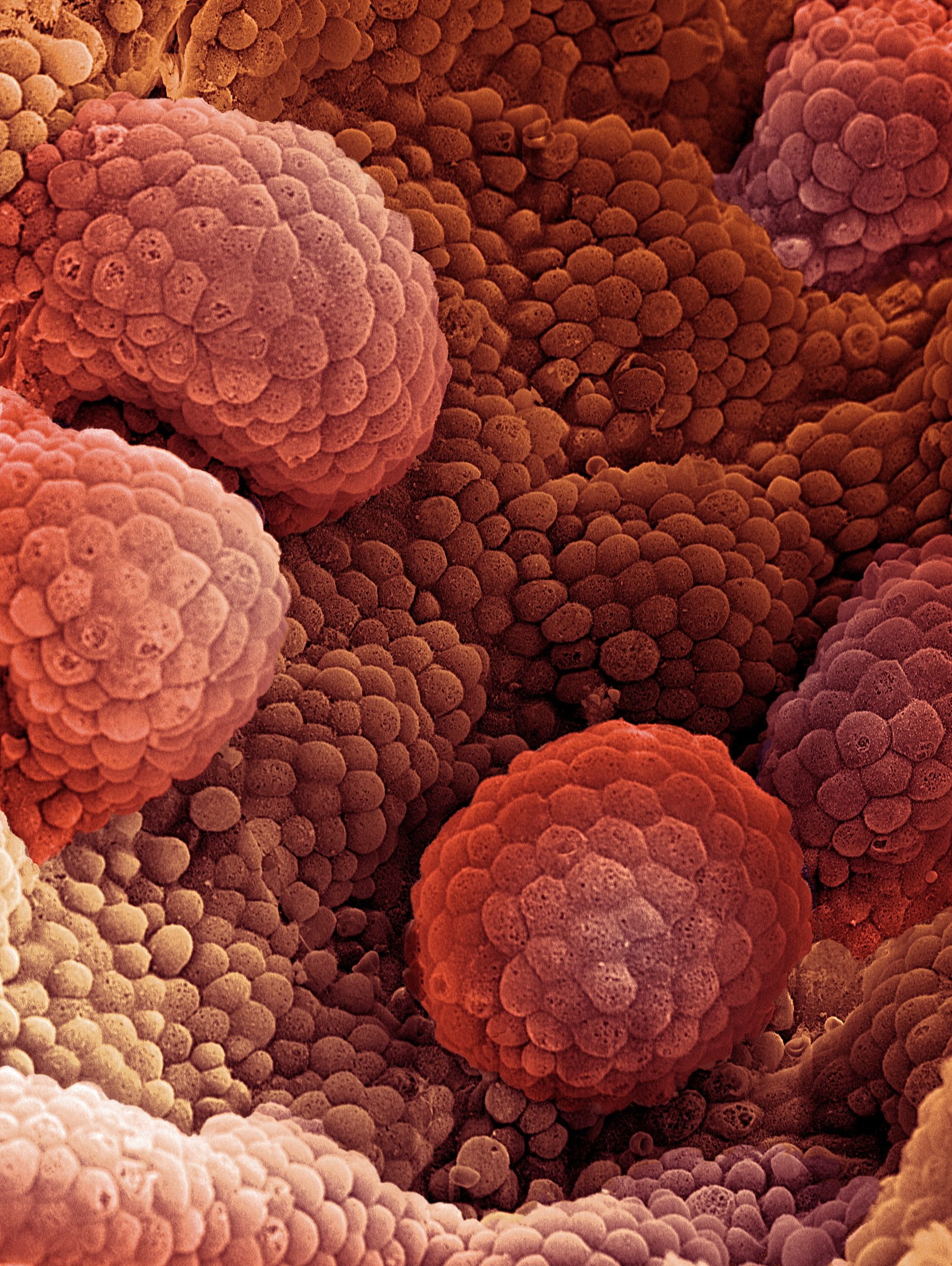 Что такое онкология. Онкологические клетки. Злокачественные клетки.